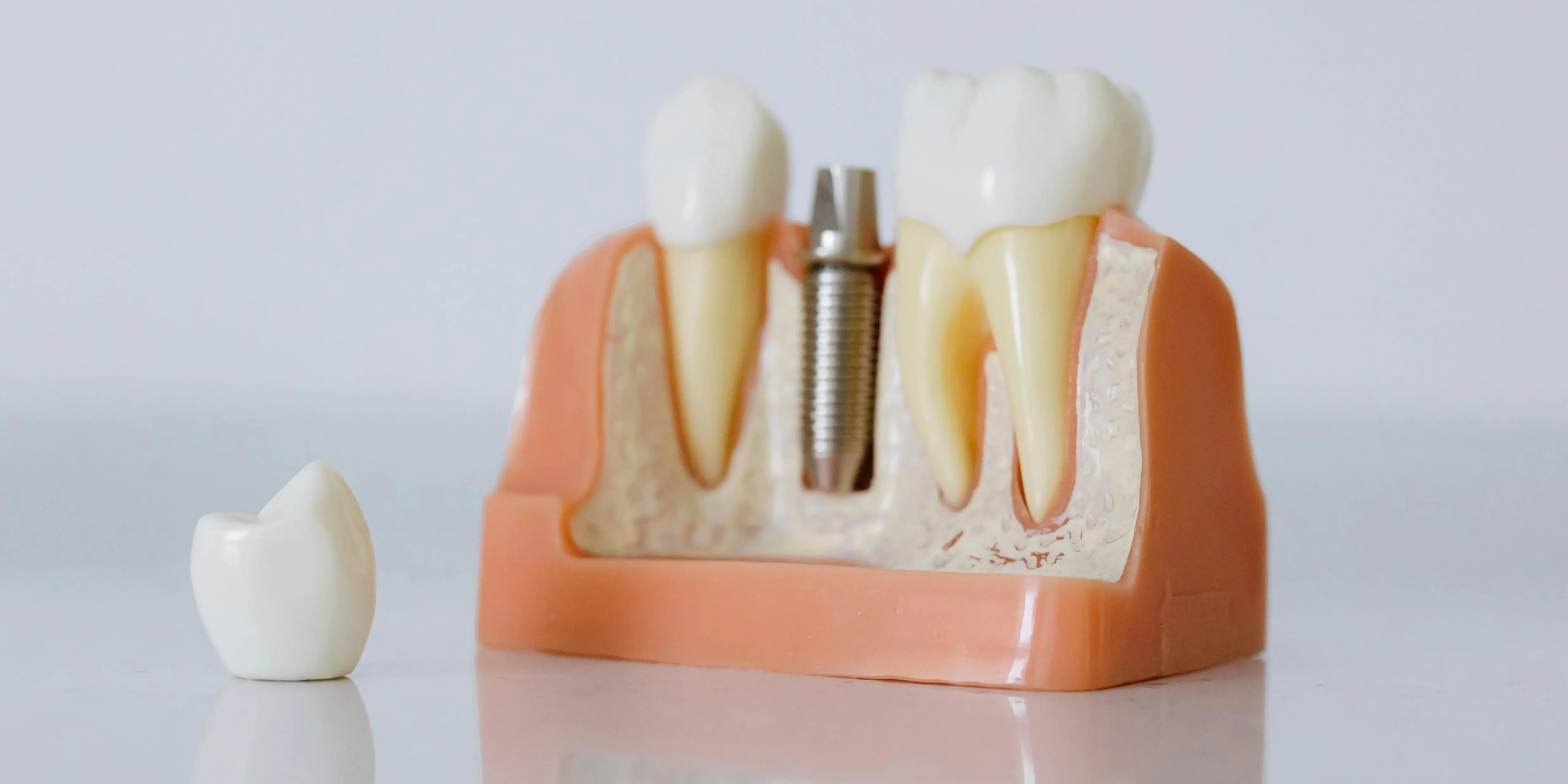 Dental Implant